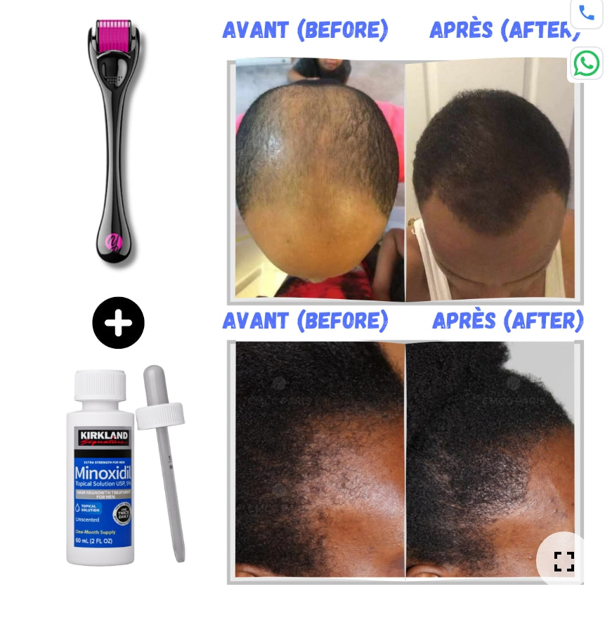 Minoxidil 5% – Traitement Anti-Chute & Repousse des Cheveux