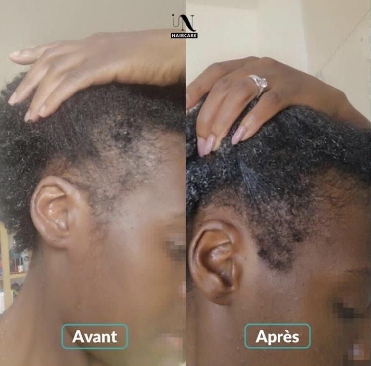 Reprenez le Pouvoir sur Votre Chevelure – Kit Complet Repousse & Densité Intense 💪🔥
