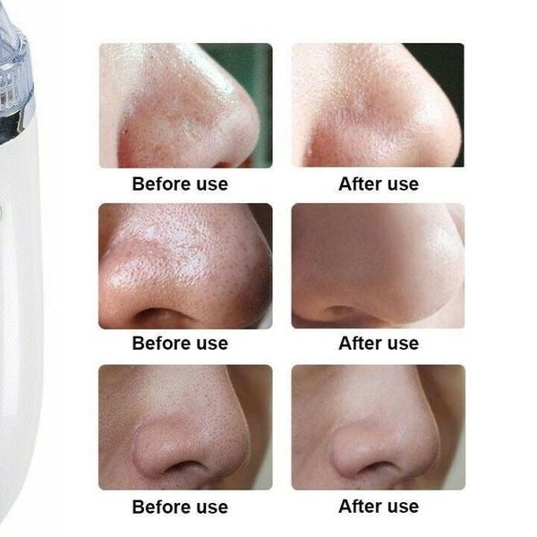 Comédon électrique, Appareil de soin du visage anti points noirs